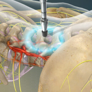 Neuropercutor estructural. Valoracion y tratamiento